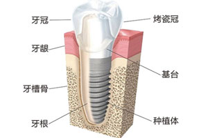 合肥种植牙价格？_合肥种植牙费用