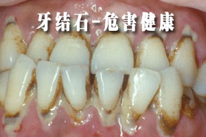 牙周炎有什么危害？