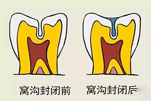 什么时候做窝沟封闭的可靠？