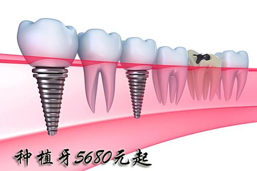合肥种植牙价格?
