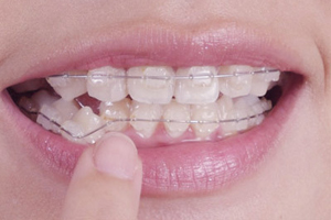 牙齿错位的危害？