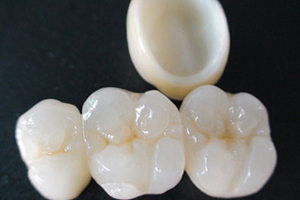 合肥瓷贴面治疗四环素沉着牙需要多久?