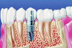 常见的种植牙的材料有哪些?