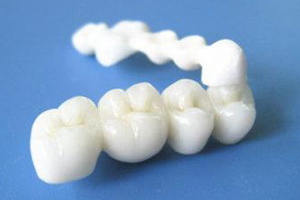 合肥的全瓷牙修复牙齿缺失有哪些优势?