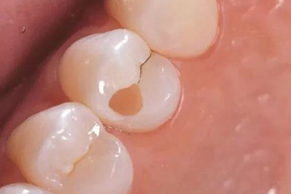 龋坏补牙的材料有哪些？