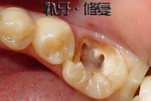 根管的治疗后牙齿寿命有多长？