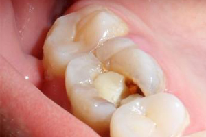 当智齿蛀了牙了是拔掉还是治疗？