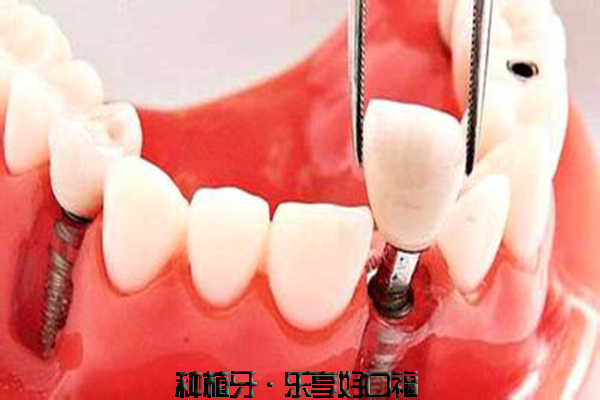 为什么现代人都选择种植牙做牙齿修复？