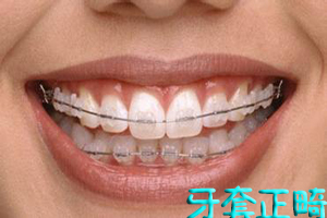 关于牙齿矫正的方法有哪些呢？