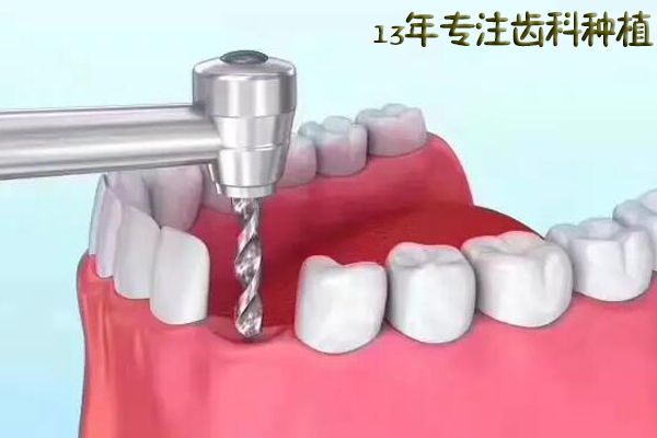 合肥全口牙缺失价钱是多少？