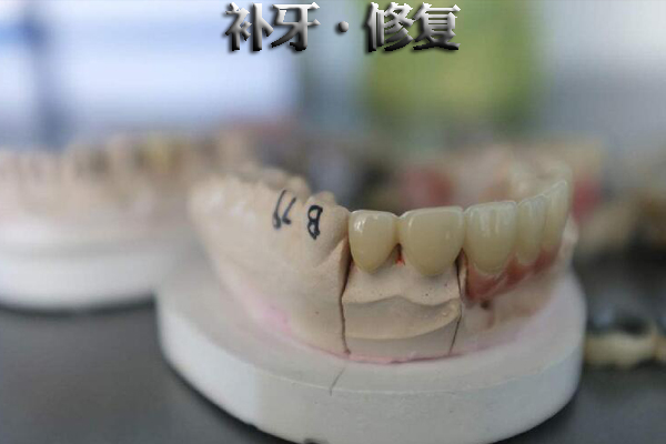 复合树脂补牙