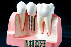 种植牙修复误区