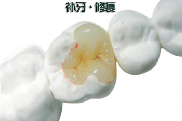补牙过程是什么?