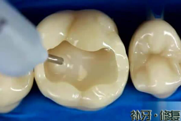 补牙过程是什么?