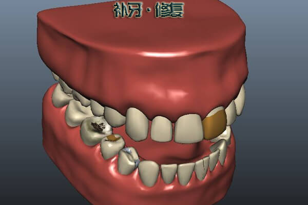 补牙过程是什么?