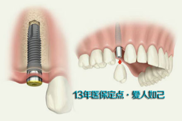 种植牙骨结合多长时间