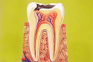 合肥蛀了牙根管的治疗多少钱？