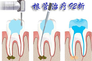 根管的治疗