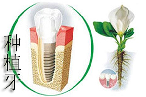 合肥牙科种植牙价钱？