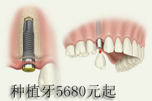 合肥牙科种植牙价钱？