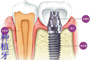 合肥种植牙大概多少钱？