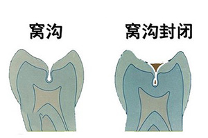 合肥窝沟封闭价格多少？