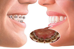 合肥成人牙颌面畸形的矫正方法有哪些？