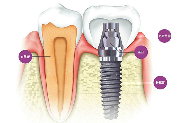 合肥做种植牙选什么材料好？