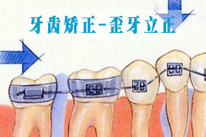 合肥矫正牙齿不齐要多少钱？