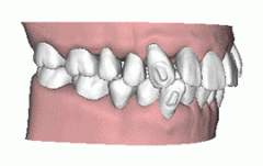 合肥牙颌面畸形矫正需要多少钱？