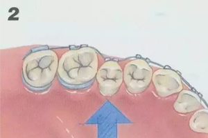 合肥成人牙齿正畸要多少钱？