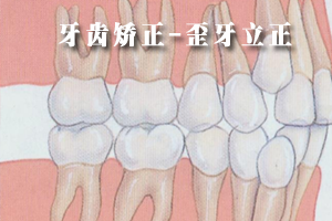 合肥矫正牙齿拥挤费用多少？