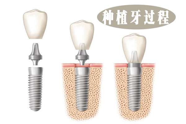 种植牙价格多少？