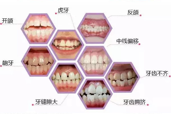 合肥矫正牙颌面畸形要多少钱？