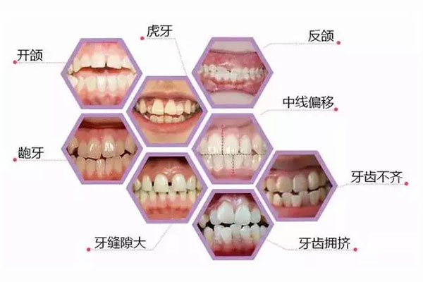 合肥牙齿隐形矫正多少钱？