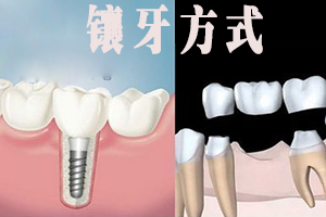 牙齿缺失镶牙方法有哪些？