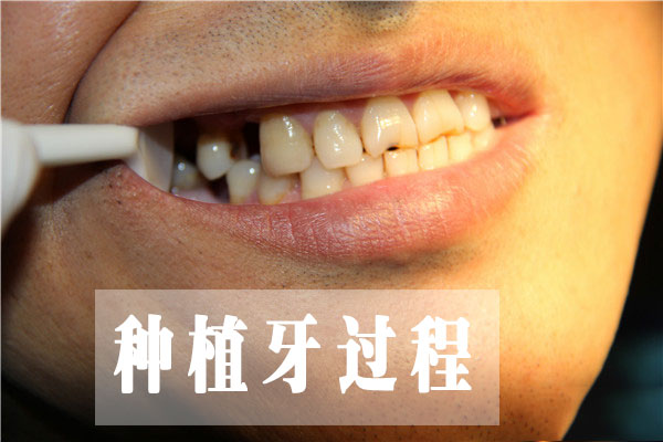 合肥哪家种植牙口腔医院好
