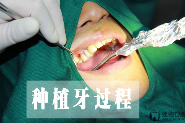 合肥哪家种植牙口腔医院好