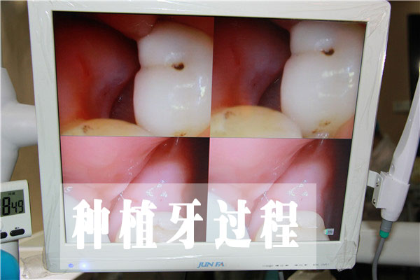 合肥哪家种植牙口腔医院好