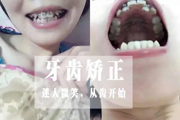 合肥哪家做牙齿矫正好