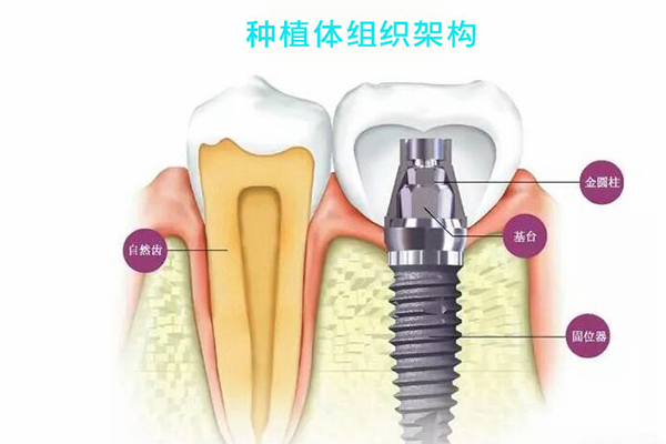 合肥种植牙的价格