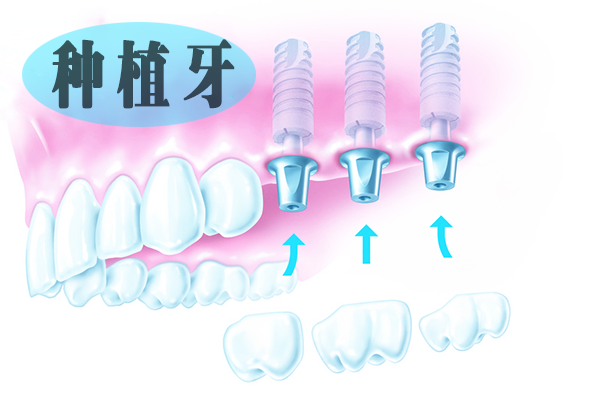 合肥种植牙要多少钱？