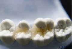 合肥牙有洞补需要多少钱？