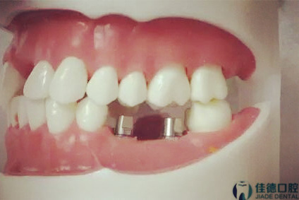 合肥口腔科种植牙哪家好？