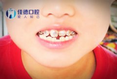 合肥儿童牙颌面畸形矫正多少钱？