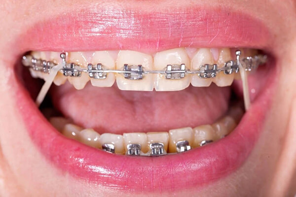 合肥牙齿正畸一般费用多少？