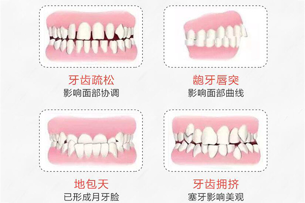 牙齿畸形种类