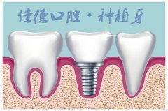 合肥哪家口腔种植牙便宜?