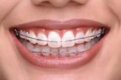  合肥牙齿矫正哪家好-如何选择才能不上当?