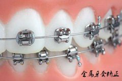 合肥牙齿矫正-什么类型适合你？